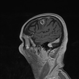 Brain metastasis (Radiopaedia 42617-45761 Sagittal T1 C+ 17).jpg