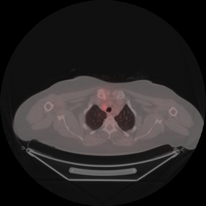 Brain metastasis (Radiopaedia 89847-106962 Axial lung window 6).jpg