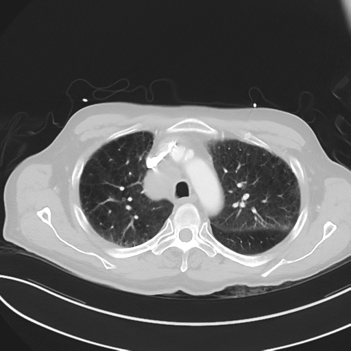 File:Brain metastasis (lung cancer) (Radiopaedia 48289-53180 Axial lung window 18).png