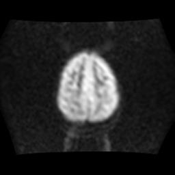 File:Brainstem glioma (Radiopaedia 30923-31624 Axial DWI 15).jpg