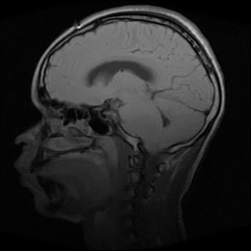 File:Brainstem glioma (Radiopaedia 30923-31624 Sagittal T1 8).jpg
