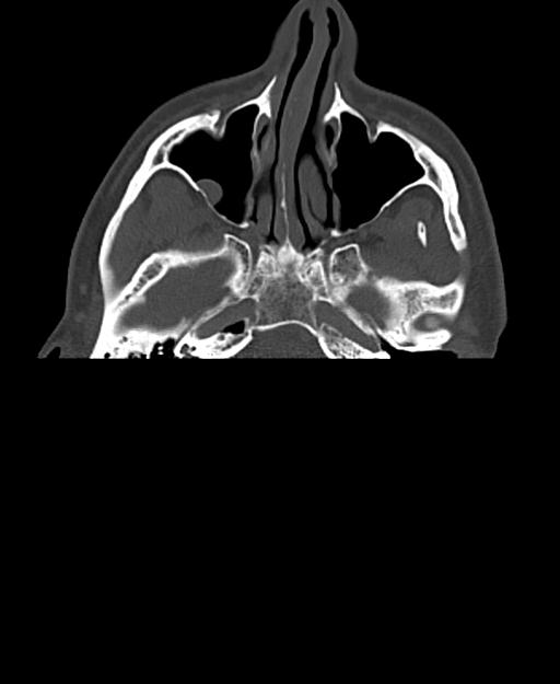 Branchial cleft cyst (Radiopaedia 31167-31875 Axial bone window 5).jpg