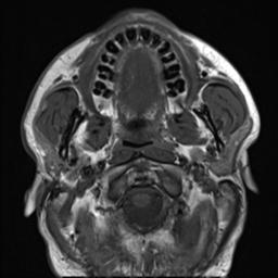 File:Branchial cleft cyst (Radiopaedia 31167-31876 Axial T1 22).jpg