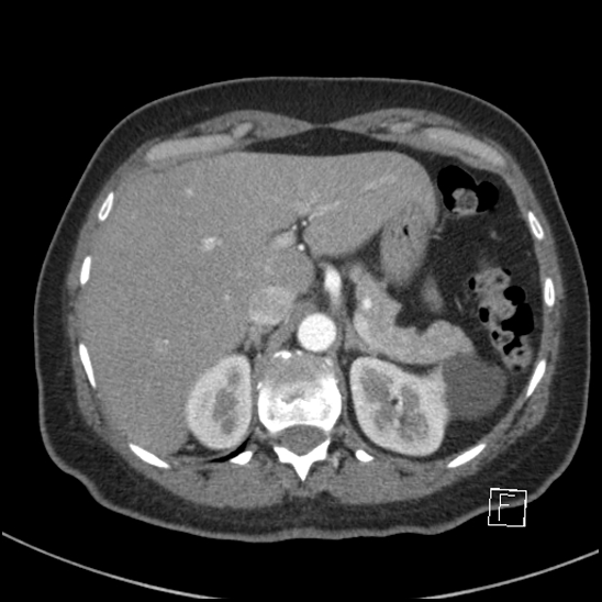 Breast metastases from renal cell cancer (Radiopaedia 79220-92225 A 89).jpg