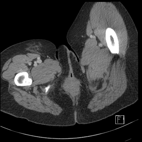 File:Breast metastases from renal cell cancer (Radiopaedia 79220-92225 C 137).jpg