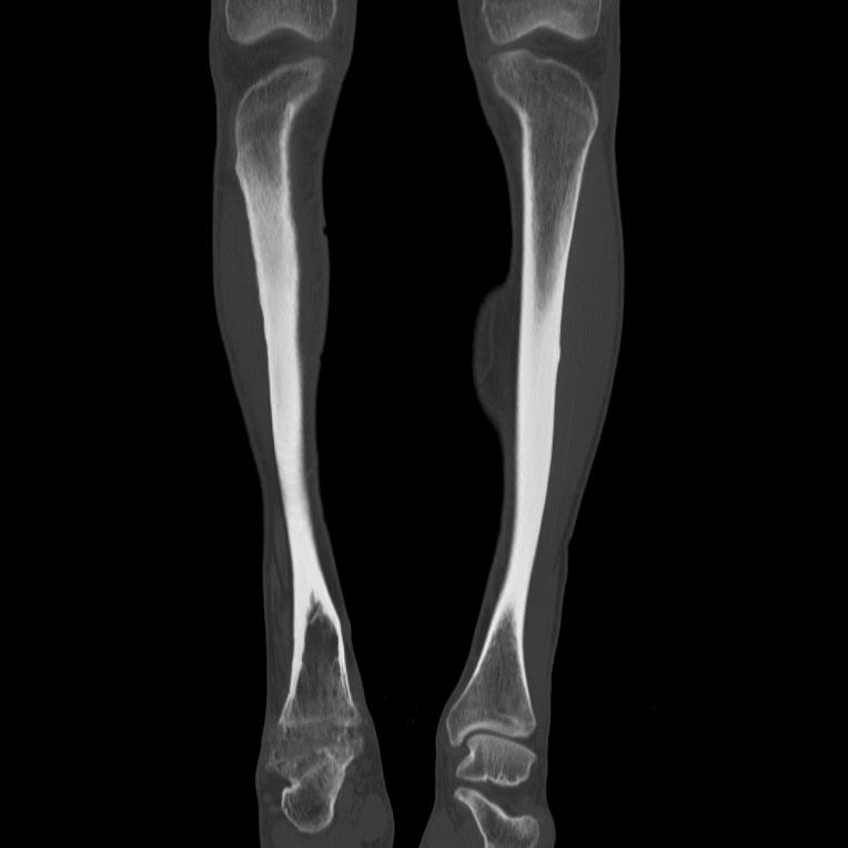 Brodie abscess - tibia (Radiopaedia 66028-75204 Coronal bone window 9).jpg