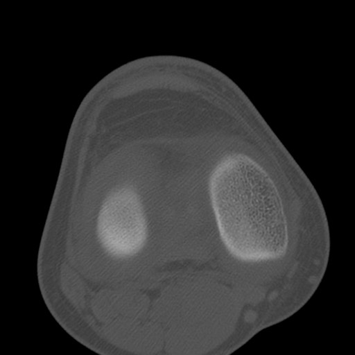 Brodie abscess of the tibia (Radiopaedia 58984-66250 Axial bone window 51).jpg