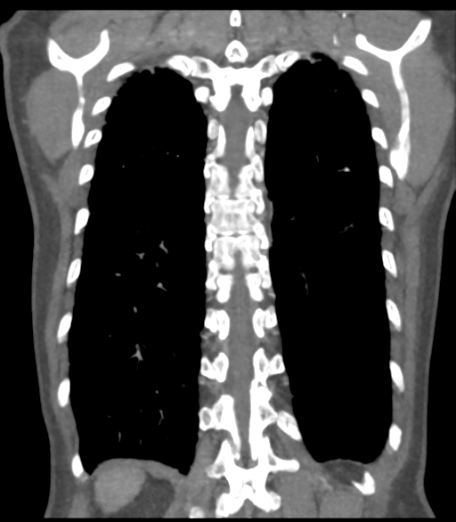 File:Bronchial artery aneurysms (Radiopaedia 42282-45385 Coronal C+ delayed 53).png