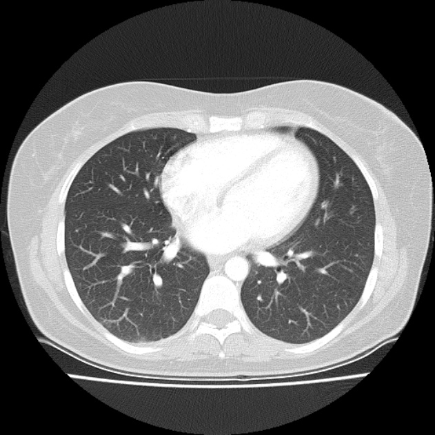 Bronchial atresia (Radiopaedia 22965-22992 Axial lung window 21).jpg
