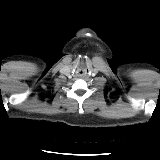 Bronchial carcinoid tumor (Radiopaedia 67377-76764 A 2).jpg
