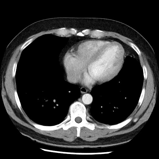 Bronchial carcinoid tumor (Radiopaedia 67377-76764 A 43).jpg