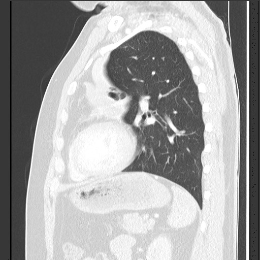 Bronchial carcinoid tumor (Radiopaedia 67377-76764 Sagittal lung window 48).jpg