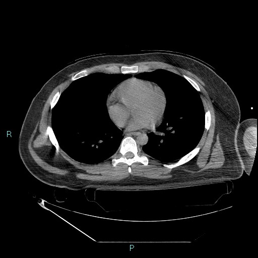 File:Bronchial carcinoid tumor (Radiopaedia 78272-90870 Axial non-contrast 64).jpg