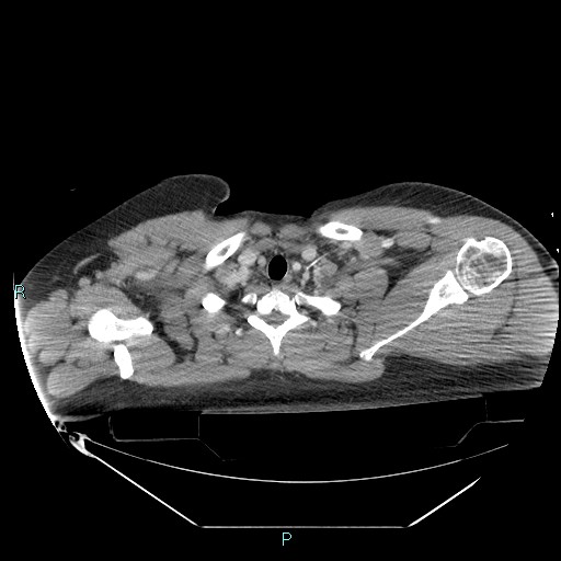 Bronchial carcinoid tumor (Radiopaedia 78272-90870 C 17).jpg