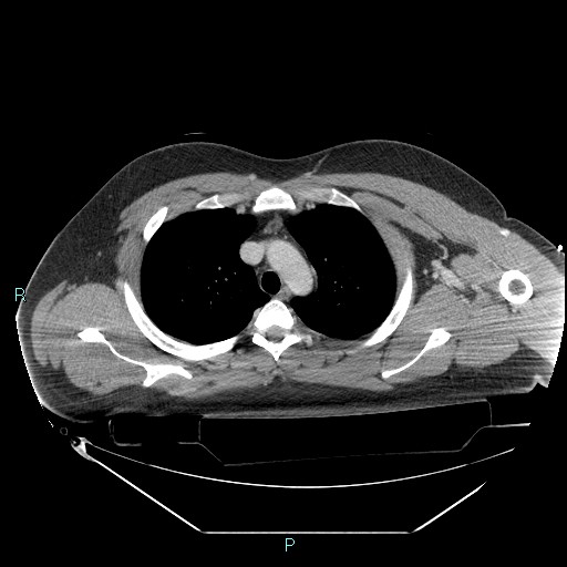 File:Bronchial carcinoid tumor (Radiopaedia 78272-90870 C 36).jpg