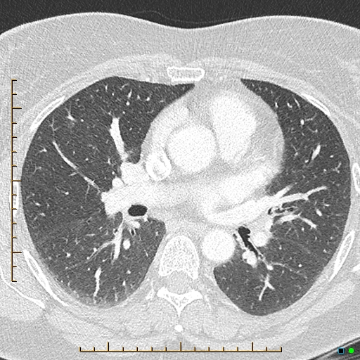 Bronchial diverticula (Radiopaedia 79512-92676 Axial lung window 94).jpg