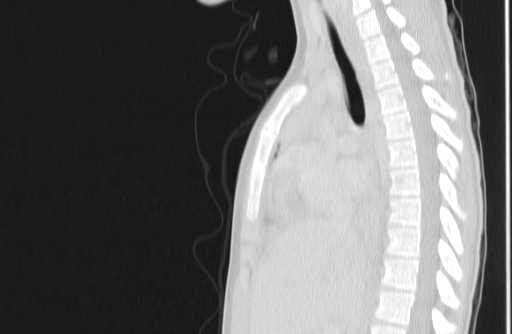 File:Bronchial mucoepidermoid carcinoma (Radiopaedia 57023-63895 Sagittal lung window 77).jpg