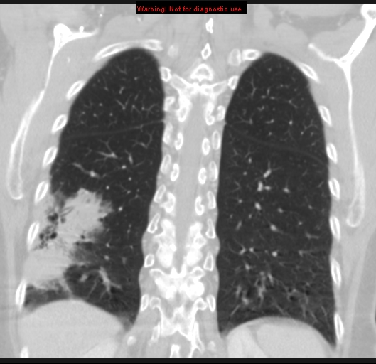 Bronchoalveolar carcinoma (BAC) (Radiopaedia 13436-13392 Coronal lung window 46).jpg