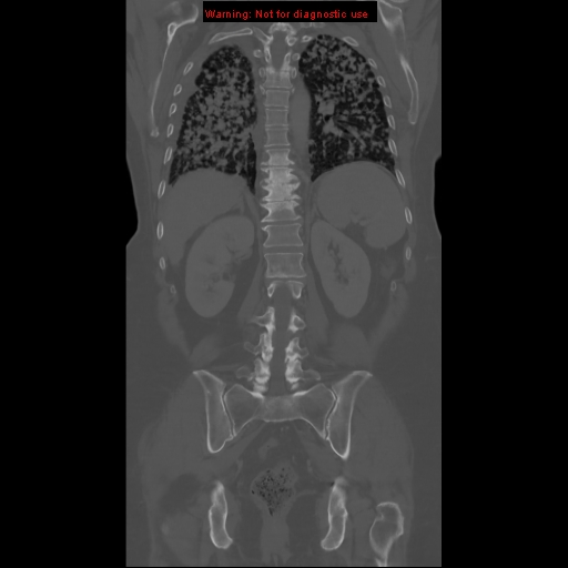 File:Bronchoalveolar carcinoma (Radiopaedia 13224-13233 Coronal non-contrast 18).jpg