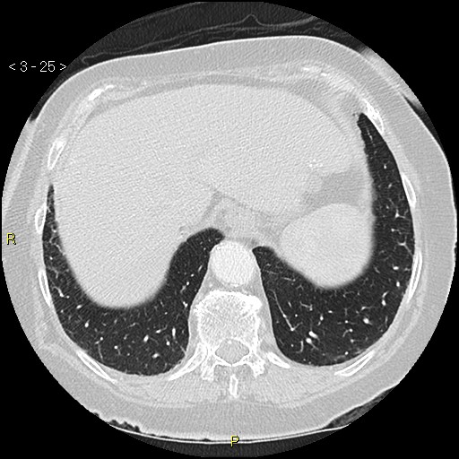 Bronchogenic carcinoma as an incidental finding (Radiopaedia 16453-16130 Axial lung window 25).jpg