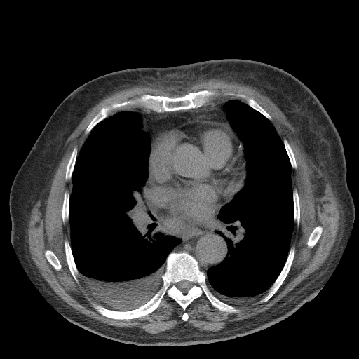 Bronchogenic carcinoma with metastatic lymphadenopathy (Radiopaedia 37671-39569 Axial non-contrast 31).jpg