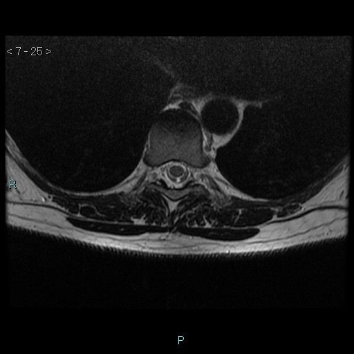 File:Bronchogenic cyst - posterior mediastinal (Radiopaedia 43885-47365 Axial T2 25).jpg