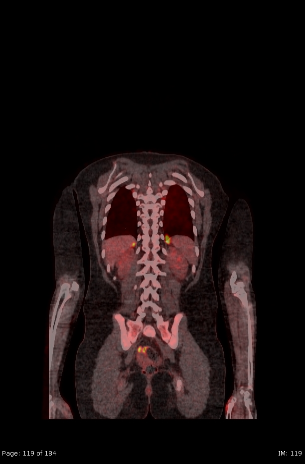 Brown fat uptake (FDG PET-CT) (Radiopaedia 77392-89513 Fused coronal 77).jpg