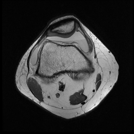 File:Bucket handle meniscus tear (Radiopaedia 56916-63751 Axial PD 4).jpg