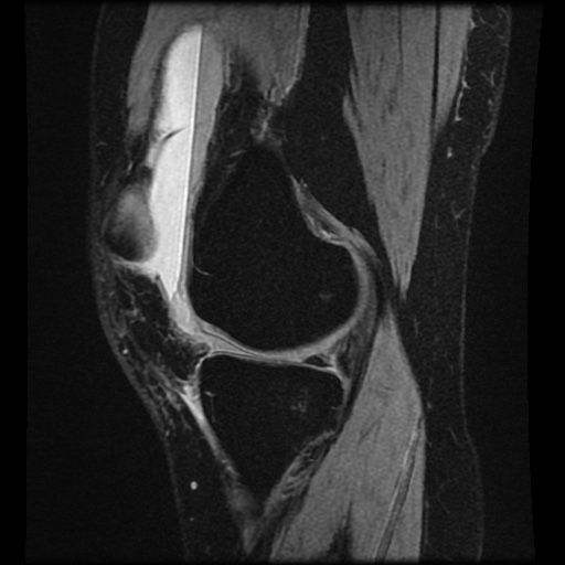 Bucket handle meniscus tear (Radiopaedia 56916-63751 H 56).jpg