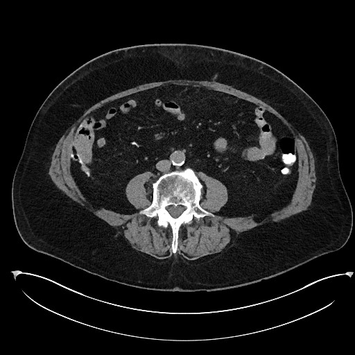 Buried bumper syndrome - gastrostomy tube (Radiopaedia 63843-72577 Axial Inject 69).jpg