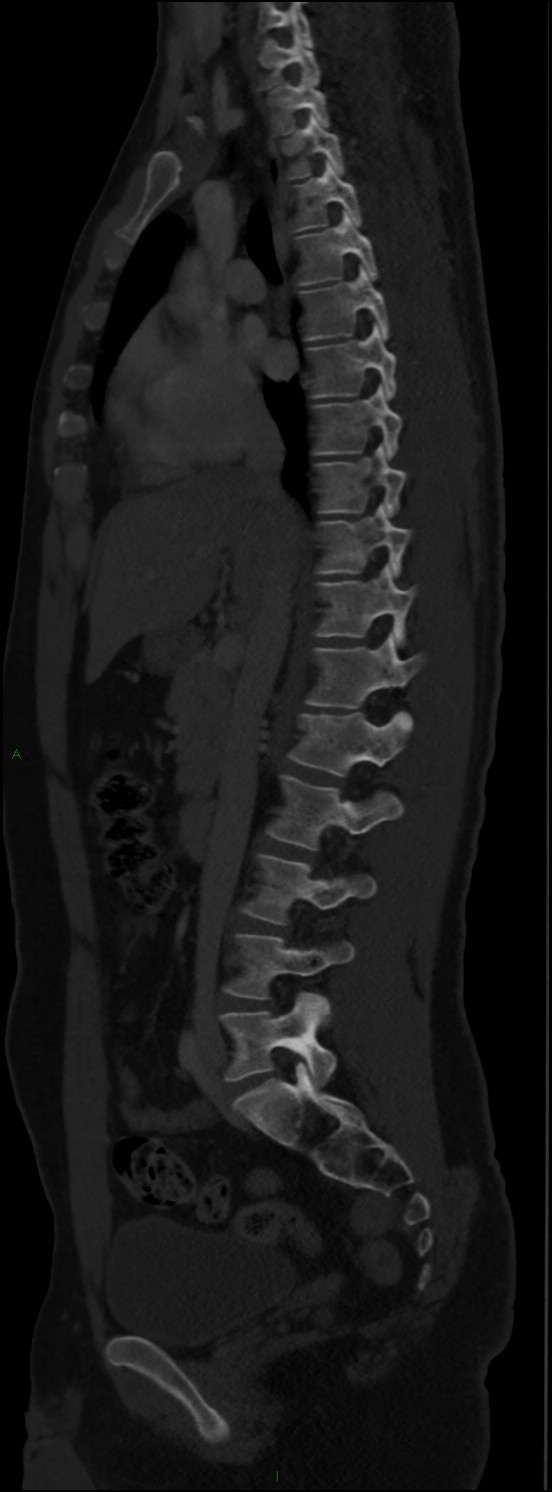 Burst fracture (Radiopaedia 83168-97542 Sagittal bone window 62).jpg