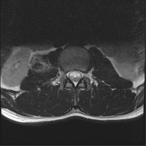 File:Burst fracture - T12 with conus compression (Radiopaedia 56825-63646 Axial T2 2).png