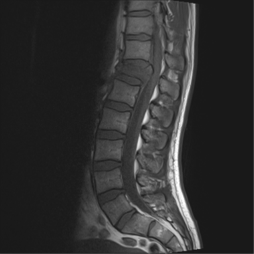 File:Burst fracture - T12 with conus compression (Radiopaedia 56825-63646 Sagittal T1 8).png