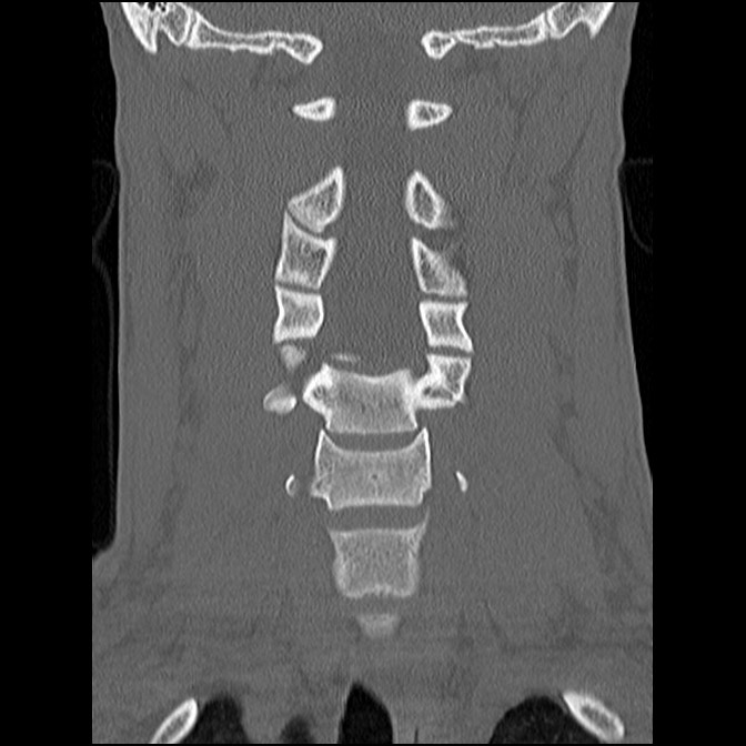 C5 facet fracture (Radiopaedia 58374-65499 Coronal bone window 31).jpg