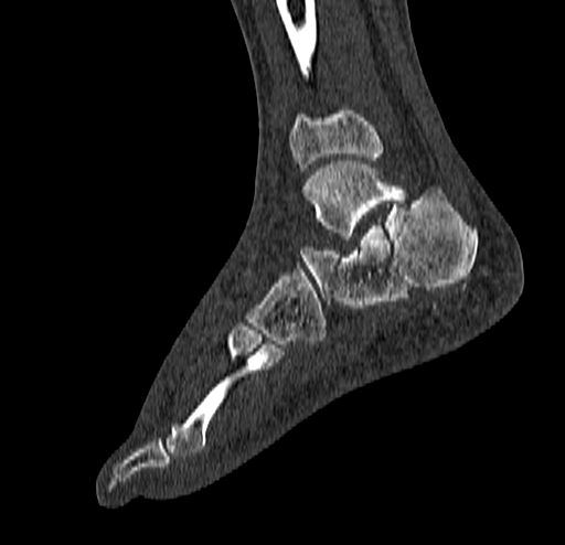 Calcaneal fracture - Sanders type 4 (Radiopaedia 90179-107370 Sagittal bone window 59).jpg