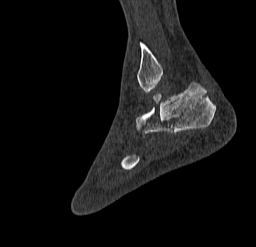 Calcaneal fracture - Sanders type 4 (Radiopaedia 90179-107370 Sagittal bone window 69).jpg