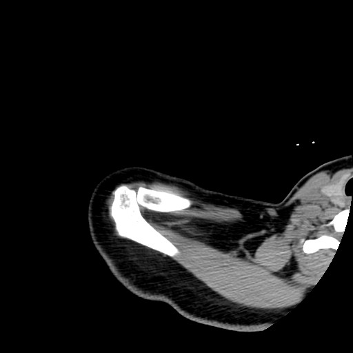 File:Calcific tendinitis of the infraspinatus tendon (Radiopaedia 87256-103539 B 12).jpg