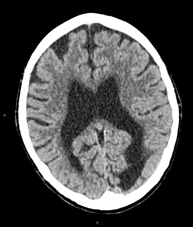 Calcified cerebral emboli from left ventricular thrombus (Radiopaedia 84420-99758 Axial non-contrast 40).jpg