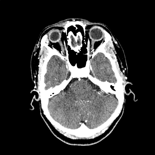 Calcified cerebral hydatid cyst (Radiopaedia 65603-74717 Axial with contrast 14).jpg
