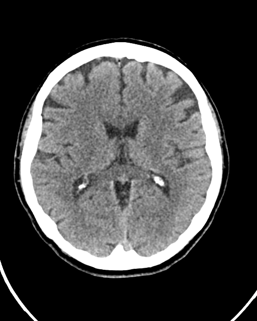 Calcified meningioma (Radiopaedia 74361-85243 Axial non-contrast 24).jpg