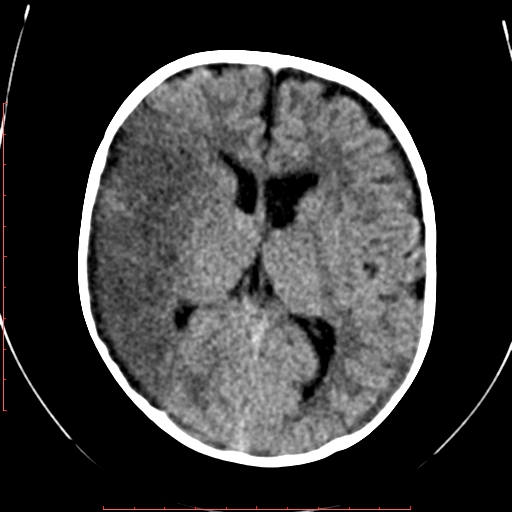 File:Calcified middle cerebral artery embolism (Radiopaedia 78949-91860 Axial non-contrast 14).jpg