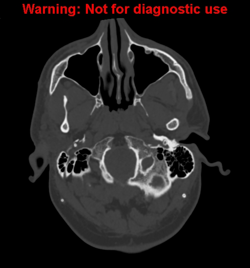 File:Calvarial thickening from chronic shunting (Radiopaedia 60079-67637 Axial bone window 14).jpg