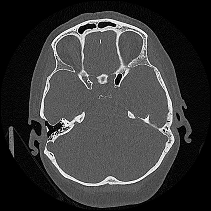 Canal up mastoidectomy (Radiopaedia 78108-90638 Axial bone window 104).jpg