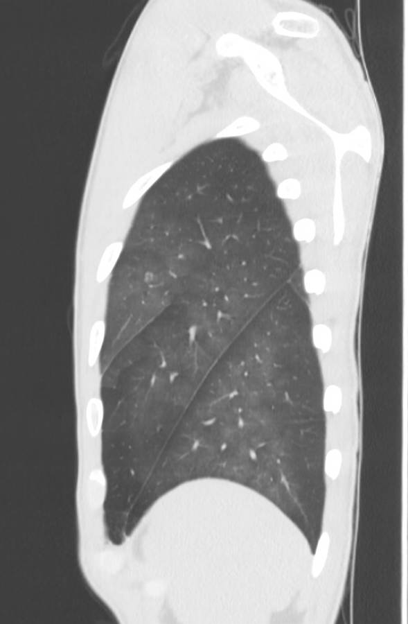Cannabis-induced diffuse alveolar hemorrhage (Radiopaedia 89834-106946 Sagittal lung window 123).jpg