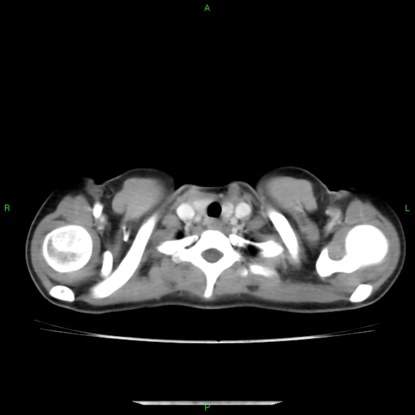 File:Cannon ball metastases - synovial sarcoma (Radiopaedia 26135-26271 C 3).jpg