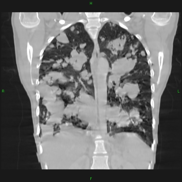 File:Cannon ball metastases - synovial sarcoma (Radiopaedia 26135-26271 Coronal lung window 12).jpg