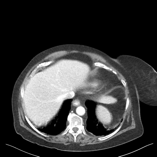 Cannonball metastases from endometrial cancer (Radiopaedia 42003-45031 E 14).png