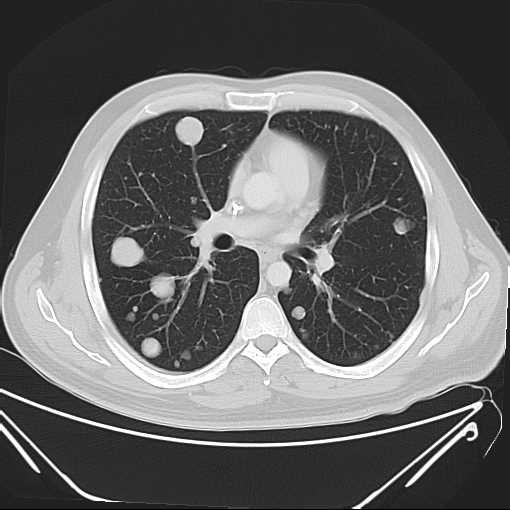 File:Cannonball pulmonary metastases (Radiopaedia 67684-77101 Axial lung window 12).jpg