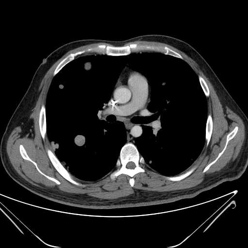 File:Cannonball pulmonary metastases (Radiopaedia 67684-77101 D 128).jpg