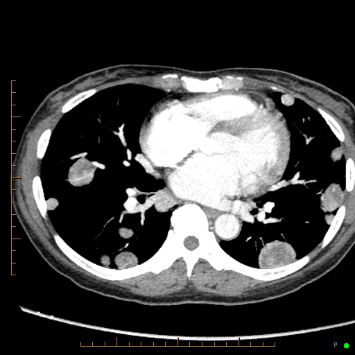 Canonball lung metastasis (Radiopaedia 77634-89837 B 57).jpg